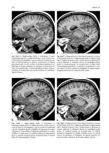 脑MRI图集高清英文版 - J. C. Tamraz, Springer, 2006_部分23