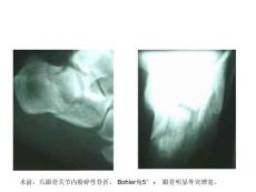 医学资料-术前：右跟骨关节内粉碎性骨折, bohler角5。,跟骨明显外突增宽。-ppt课件
