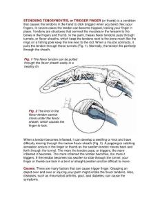 STENOSING TENOSYNOVITIS, or TRIGGER FINGER (or thumb) is a