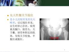 先天性髋关节脱位ppt精选课件