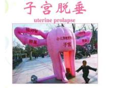 子宫脱垂ppt课件