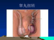 睾丸扭转ppt课件
