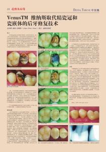 VenusTM 維納斯取代精瓷冠和瓷嵌體的后牙修復技術(shù)