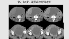 胃肠道间质瘤误诊分析