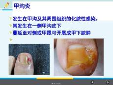 护理专业《甲沟炎》