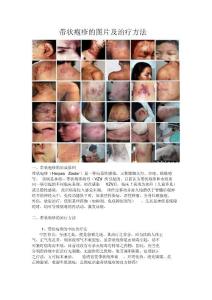 带状疱疹图片