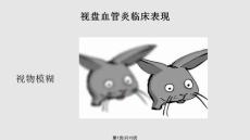 视盘血管炎学习
