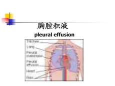 胸腔积液.