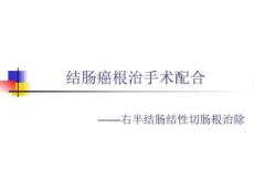 《结肠癌根治手术》