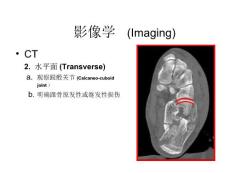 跟骨骨折影像学