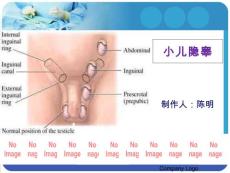 小儿隐睾ppt课件