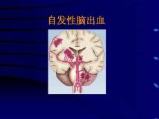 自发性脑出血