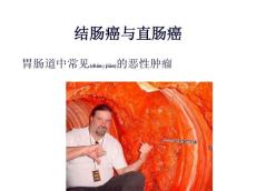 结肠癌与直肠癌