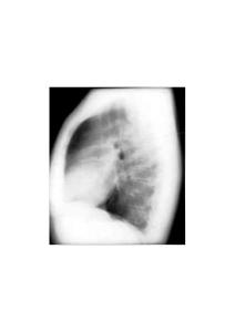 正常表現(xiàn) 正常心臟左側(cè)位片