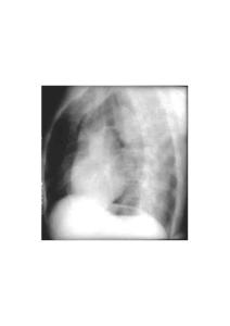 正常表現(xiàn) 正常心臟左前側(cè)位片