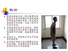 强直性脊柱炎