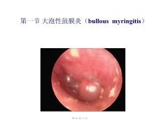 大泡性鼓膜炎 PPT课件