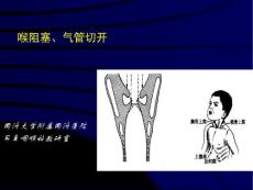 喉阻塞气管切开