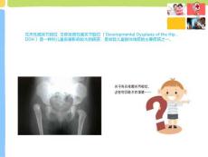 先天性髋关节脱位王栋