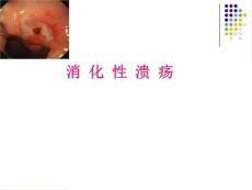 消化性溃疡-wxPPT