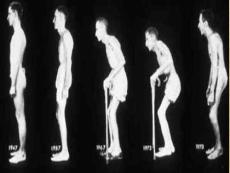 强直性脊柱炎