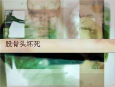 股骨头坏死PPT课件