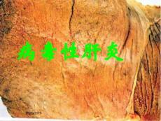 病毒性肝炎肝炎;肝硬化