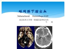 蛛网膜下腔出血教案