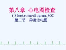 异常心电图心肌缺血心肌梗死