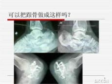 跟骨骨折复位课件