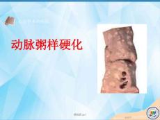 动脉粥样硬化