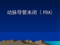 动脉导管未闭PDA
