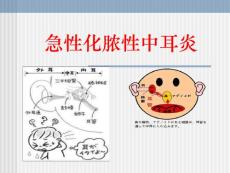急性化脓性中耳炎