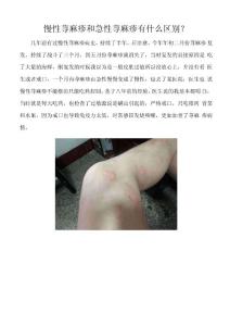 慢性荨麻疹与急性荨麻疹,一招轻松搞定