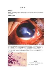 精选角膜病