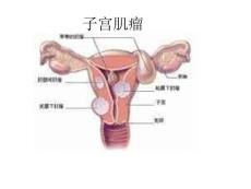 子宫肌瘤课件