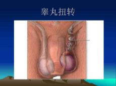 睾丸扭转17240