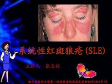 系统性红斑狼疮1811683