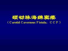 颈动脉海绵窦瘘