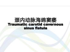 颈内动脉海绵窦瘘