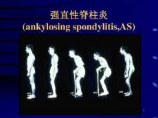 强直性脊柱炎14258