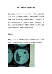 最新：结核性心包炎的诊断与治疗