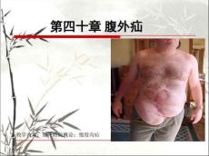 腹外疝PPT课件