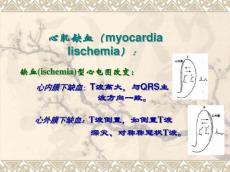 心肌缺血心电图