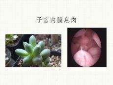 子宫内膜息肉诊治