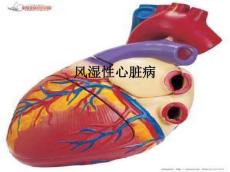 风湿性心脏病ppt课件