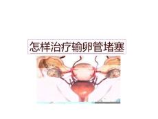 怎样治疗输卵管堵塞