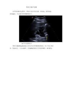 肾结石超声诊断