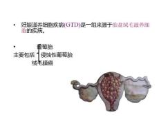 妊娠滋养细胞疾病的护理