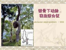 锁骨下动脉盗血综合征ppt课件
